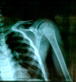 Let your physician set the bones, then come see us. Acupuncture can decrease your pain and improve your function so you make the most out of your physical therapy for a more complete recovery.