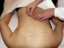 Acupuncture points on the back relieve back pain and influence the internal organs.