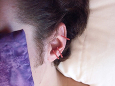 Patient relaxing with ear acupuncture. Ear points are especially good at calming the spirit.   