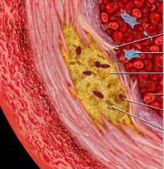 atherosclerosis