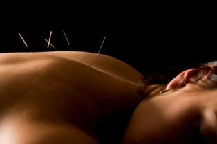 acupuncture on the back